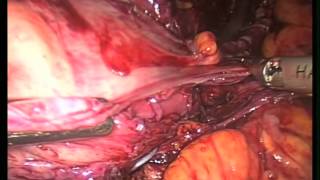LAPAROSCOPIC RECURENT HIATAL HERNIA WITH PREV MESH AND COLLIS GASTROPLASTY REPAIR FOR THE TREATMENT
