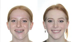 Corrective Jaw Surgery with Drs. Relle and Walline | Los Angeles