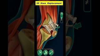Total Knee Replacement 3D Animation.#shorts #medicaleducation