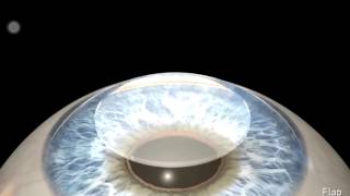 Lasik wavefront guided