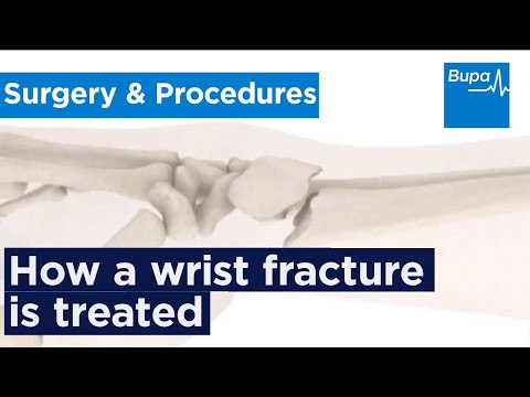 How a wrist fracture is treated How a wrist fracture is treated