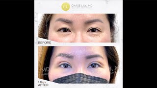 Nurse SieYeon's Revision Eyelid Surgery Recovery Experience! Week 1 Update #ChaseLayMD