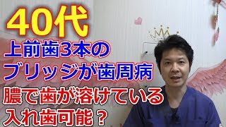 40代ですが上の前歯3本のブリッジが歯周病になりました、膿で歯が溶けている場合に入れ歯は可能ですか？【千葉市中央区の歯医者】