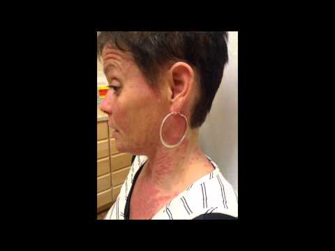 How I got rid of Cutaneous Lupus How I got rid of Cutaneous Lupus