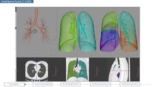 Philips IntelliSpace Portal clinical application CT COPD (chronic obstructive pulmonary disease)