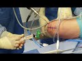 arthroscopic bone marrow harvesting from the intercondylar notch of the knee