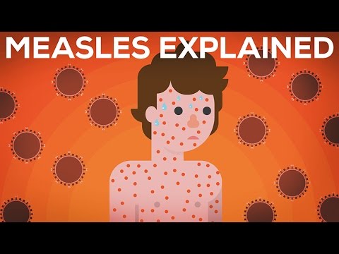 Measles Explained — Vaccinate or Not? Measles Explained — Vaccinate or Not?