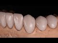 3d Ortholine porceline veneer case