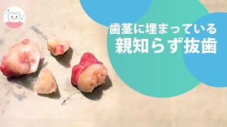 右下の歯茎に埋まっている親知らずの抜歯‼︎Lower Wisdom Tooth Extraction