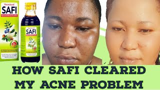 SAFI BLOOD PURIFIER/ REVIEW ON BEST DETOX DRINK FOR ACNE/ CLEAR ACNE IN 2WEEKS