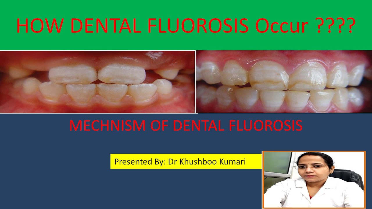 Mechanism Of Dental Fluorosis, Enamel Defect,Stages Of Enamel ...