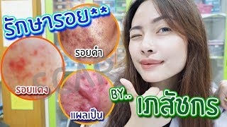 #7 รักษารอยดำ, รอยแดงและแผลเป็น (Acne Scar Treatment) โดยเภสัชกร 🌏 เภสัชท่องโลก