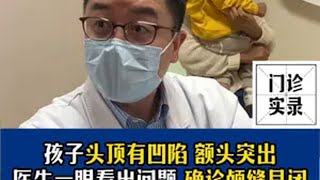 孩子头顶有凹陷 额头突出,医生一眼看出问题 确诊颅缝早闭 医学科普 颅缝早闭 闪闪的儿科医生 宝宝头型