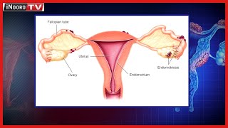 Thibitarĩ wa ACK kũheana ũrigiti wa mũrimũ wa Endometriosis hatarĩ marĩhi, Kerugoya