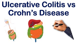 Ulcerative Colitis vs Crohn's Disease Part 1| STEP NCLEX COMLEX