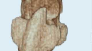 33 Day Human Embryo, Carnegie Stage 15