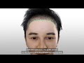 ปลูกผมถาวร เทคนิค dhi hair transplant โดย dr. danai bangkok hair transplant