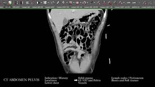 [CT] Abdomen Pelvis | Search Pattern