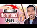 How to Get RID of Hormonal Acne | 5 Ways to Treat Hormonal Acne