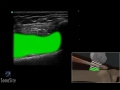 How to Ultrasound Guided Injection of the Medial Knee 3D Video