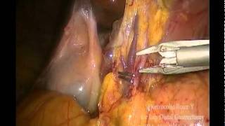 PROCEDURE AND RESULTS OF RETROCOLIC ROUX-EN Y ANASTOMOSIS FOR LAPAROSCOPIC DISTAL GASTRECTOMY -FIX T