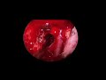 endoscopic approach to pontine cavernoma