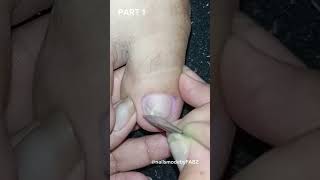 Ingrown and dry skin removal left and right foot