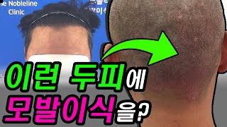 [ENG] 건선 두피 환자, 모발이식이 가능할까?_Hair transplantation of scalp psoriasis patients seen as a real case