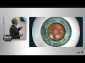 booth talk modern glaucoma management with an implant free migs approach dr. karsten klabe