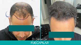 FUE Hair Transplant (2440 Grafts NW IV-Va) by Dr Gokhan Gür - FUECAPILAR, Istanbul, Turkey