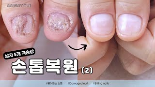 Eng sub) part 2/ Restoring the Nails of a Male Customer with Severe Nail Damage