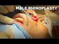 Rhinoplasty - Dr. Michael Jones | Lexington Plastic Surgeons