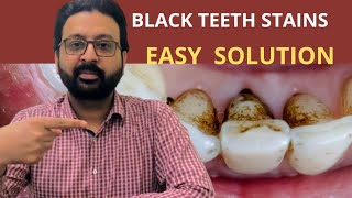 My Teeth Have BLACK STAINS | Teeth Black Stain Removal by Doctor and at Home