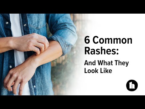 What is the most common cause of hives?