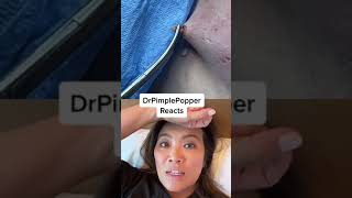 I'm not sure what she's doing! Dr Pimple Popper Reacts to Cyst Removal
