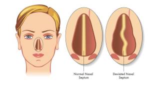 Nasal Obstruction