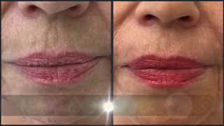 Faltenbehandlung mit 100% Bio-Filler Algeness® by Dr. Arna Shab / Frankfurt