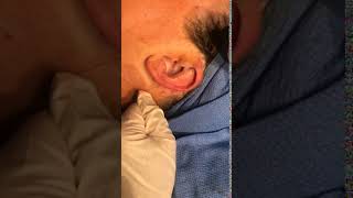 Otoplasty Surgical Technique by Dr. Tina