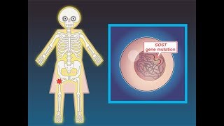 Preventing Fractures in Osteoporosis