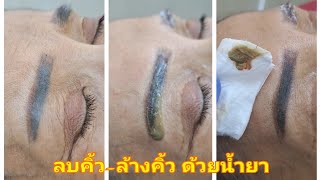 ลบคิ้วพัง-ล้างคิ้วปลิงด้วยน้ำยา