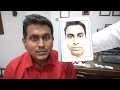 Before and After Chin Surgery (Genioplasty) - 49 Days Result - Best Transformation