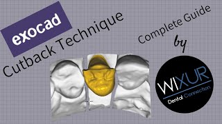 Exocad - Cutback Technique