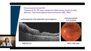 Анти-VEGF терапія макулярного набряку при оклюзії вен сітківки. Ульянова Н.А.