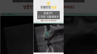 임플란트 디지털 시뮬레이션