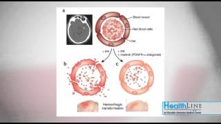 Healthline: Stroke