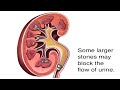 How Kidney Stones Are Formed Animation - Renal Calculi Causes & Symptoms Video - Blocked Urine Flow