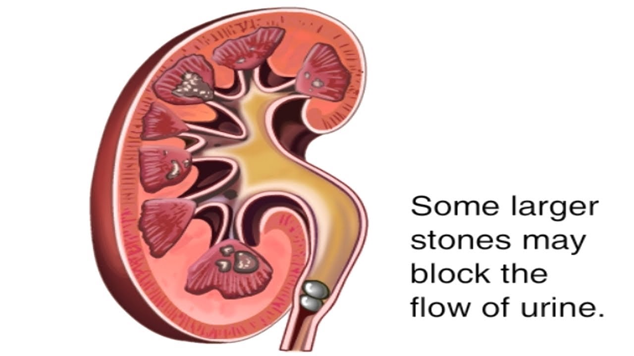 Kidney Stone Diagram