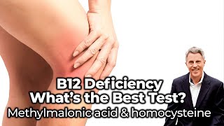 B12 Deficiency - what’s the best test? Methylmalonic acid & homocysteine - FORD BREWER MD MPH