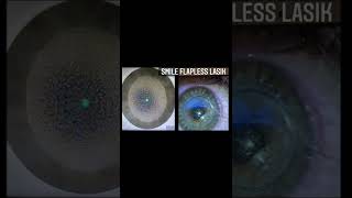 Smile Flapless Lasik at Toyos Clinic Explained