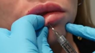 LIP FILLER Experience /Process/ Healing | What to expect •Versa Lip Filler Procedure• NYC 2021